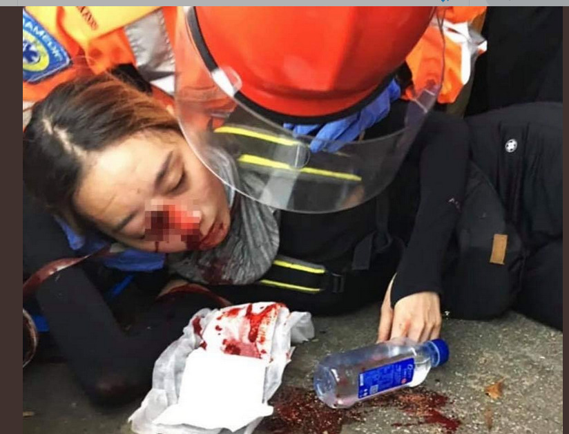 眼镜被射瞎的香港女孩